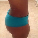 Side view with my fading burn mark