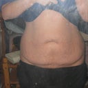 one week pre-op