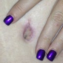 Belly button healed up