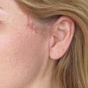 Highly visible scars and folds/pleats of skin after "mini-lift" by Professor Donald Hudson.
