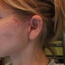 Scars and folds after "mini-lift" by Dr. Donald Hudson at Renaissance Surgical Clinic.