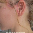 Scars and folds/pleats of skin after "mini-lift" by Dr. Donald Hudson.