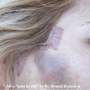 Hematoma after "mini-lift" by Dr. Donald Hudson at Renaissance Surgical Clinic.