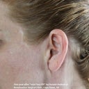 Mature wide white scars and folds/pleats of skin 12-months after "mini-lift" by Dr. Donald Hudson at Renaissance Surgical Clinic.