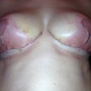 Underneath of breasts day 12 (the flash was on, it makes it look worse than it is but is easier to see some of the bruising and redness)
