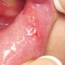 The sore in my mouth from 1 meal with the buttons- 8-28-12