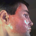 Fraxel laser of cheeks 4 hrs post procedure