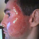 Fraxel laser of cheeks 5 hrs post procedure