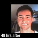 Second treatment - 48 hours later