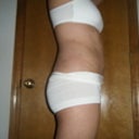 3 weeks post op