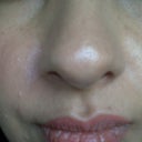 2 months after front view
