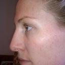 day 6-you can see how all the dark spots are gone, there are still some coffee grain spots by my hairline
