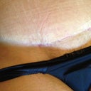 11 weeks, center of incision. the little red spots are where stitches had spit earlier in recovery.