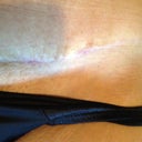 11 weeks, left side of incision.