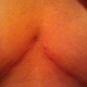 6.5 weeks, center (cleavage) scar