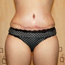 2.5 weeks PO scar, so happy I can start exercising, maybe my love handles will go away! ;)
