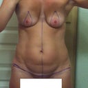 the day before surgery with my markings. I've added a line to show where i made my revision.