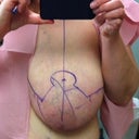 Pre-op appt. He marked me up to give me an idea of what to expect.