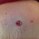 This is just minutes after my BB revision surgery. Before it got covered with bandages. Tummy very swollen.