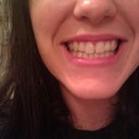 Day 1- my teeth with my first set of invisalign trays