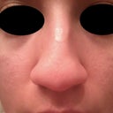 Before---You can see my crooked nose(deviated septum).