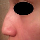 Before---Profile