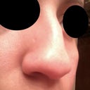 Before---Right Side (hated this angle of my nose)