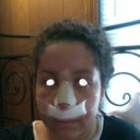 After--May 4th. My face got swollen. Chubby cheeks.