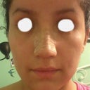 After---Cute nose now :) 8 days after surgery