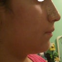 After---Love my profile! 8 days after surgery