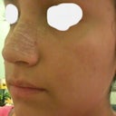 After---8 days after surgery