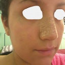 After---Right side, I love it now. 8 days after surgery.