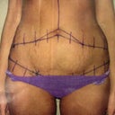 Picture Dr took in office day of surgery
Before Tummy Tuck