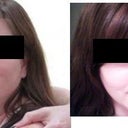 The before pic on the left was taken in August.  I had my first lipodissolve treatment in September and my second in October.  The after pic that's on the right was taken at the end of October.  (sorry it's a fuzzy cell phone pic).  