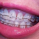 16 week right view of teeth.  Notice the wide space as the incisor is pulled away?