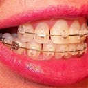 16 week left view of teeth.  Notice the wide spaces and mess this side is?  I'm embarrassed by this side.