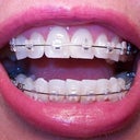 16 weeks.  It's a little weird to me how all my bottom teeth are currently being pulled to the right.  Hope they straighten that!!!