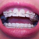 16 weeks.  It's not my imagination...all my bottom teeth are pulled to the right.  Hope they fix that:)