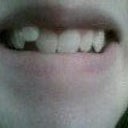 will invasalign work with my teeth? please someone answer