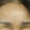 Brow Lift