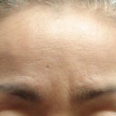 Brow Lift