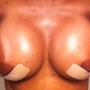 4 Weeks Post-op. aeriola incision