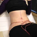 Day 1 Post Op, follow up appt w/ ps