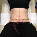 Day 1 post op.  Still a bunch of stretch marks, but no belly.  Also, stretch marks look worse b/c of compression garmet.