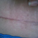 my incision looking better each week