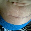 my stitches are almost fully dissolved i had few more but theyre dissapearing..my doc had to extend my incision to avoid doggy ears..im lovin it though!!