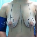 Pre surgery markings