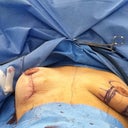 during surgery