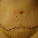 11 day post op