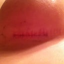 righty scar. you can still kind of see the steri-tape residue. trying to gently wash it off a little each day